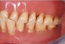m Primo step: preterapia I materiali con cui erano realizzati i denti artificiali per le protesi totali andavano incontro nel tempo ad alterazione e usura in misura maggiore rispetto a quelli attuali.