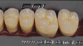 Figg. da 113 a 116 Denti con morfologia primaria/punti di contatto occlusali Figg.