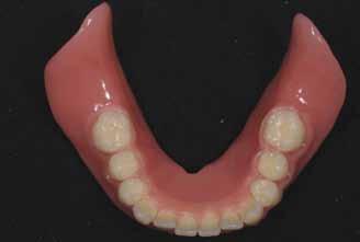 realizzazione del lavoro: un uniforme spazio funzionale libero anteriore, ottenuto in fase di montaggio dei denti dall