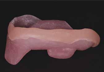 Fig. 40 Resina fotopolimerizzabile posizionata sul bordo del cucchiaio prima del Trimming in cavità orale Fig.