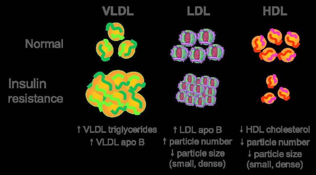 T2DM: Unique lipid profile atherogenic diabetic