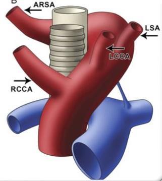 Arco aortico sinistro con arteria succlavia destra aberrante (ARSA) Si genera per regressione del segmento dell arco aortico destro tra l origine dell arteria comune destra e le arterie succlavie.