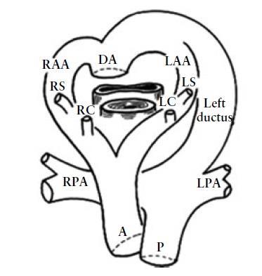 Doppio arco aortico E la più comune anomalia congenita dell arco aortico, ma anche la più difficile da riconoscere.