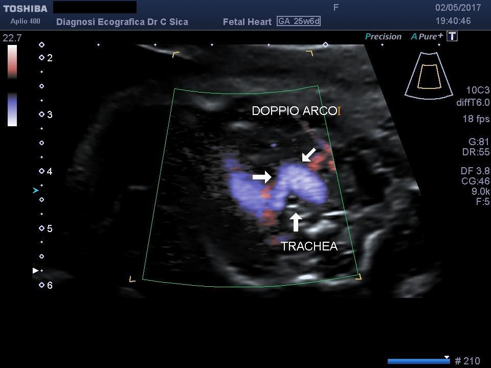 Figura 17 Altra immagine ecografica del doppio arco aortico.