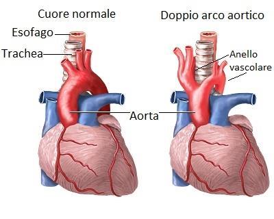 Figura 1 Raffigurazione dell'anello vascolare intorno a esofago e trachea PREVALENZA Si stima che 1-2% della popolazione generale sia affetta da anomalie dell arco aortico.