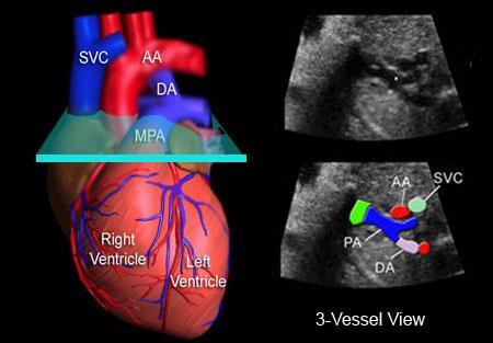 Figura 4 Scansione a "tre vasi". SVC: Vena Cava Superiore; AA: Arco aortico; DA: Dotto arterioso; MPA: Arteria Polmonare.