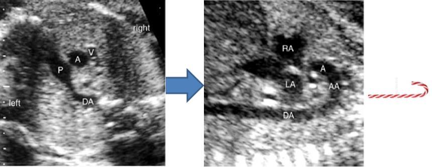 Figura 7 A sinistra visualizzazione dei tre vasi (Vena cava V, Aorta A e Arteria Polmonare P) e a destra visualizzazione dell'arco aortico dopo rotazione della sonda di 90.