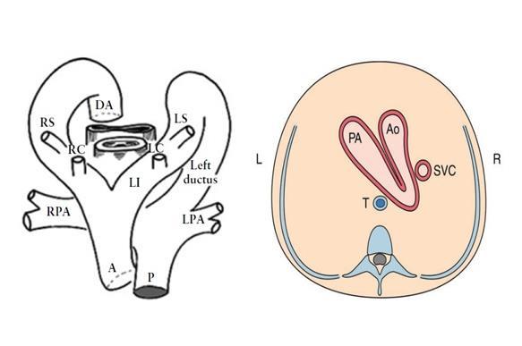 Qui di seguito le varie anomalie dell arco aortico: Arco aortico destro con ramificazione a specchio Rappresenta l anomalia dell arco aortico più frequentemente diagnosticata e si caratterizza per un