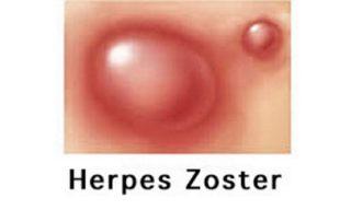 Herpes Zoster e dintorni di Maurizio Massetti* HERPES ZOSTER Generalità Aspetti storici Herpes è una parola greca che indica qualcosa di strisciante e zoster si riferiva alla cintura usata per