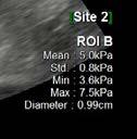 S-3D Arterial Analysis S-3D Arterial Analysis semplifica la misurazione del volume della
