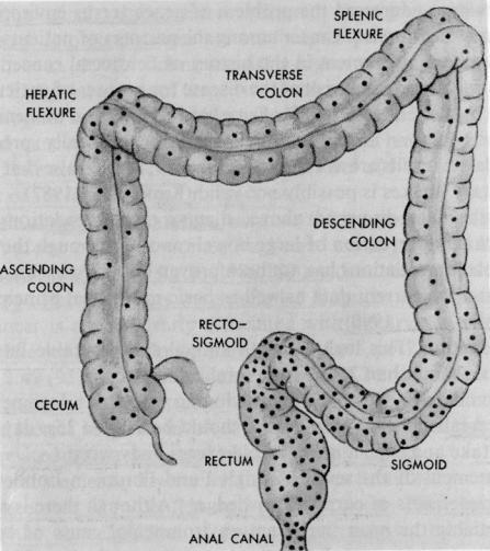 FAP attenuata (AAPC o AFAP) (1990) adenomi colorettali