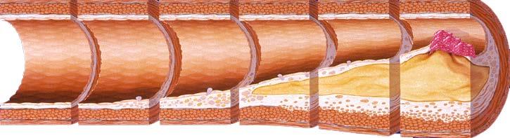 L aterosclerosi è la causa principale di MCV e può progredire in modo silente per molti anni Cellule Schiumose Strie Lipidiche Lesione Intermedia Ateroma Placca Fibrosa Lesione/Rottura Complicata