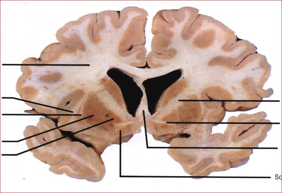 Tratto piramidale Tratto cortico-spinale Origine: Corteccia cerebrale Area 4 di Brodmann (Area Motoria Primaria)