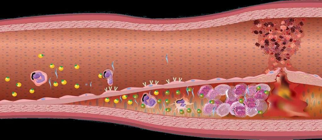 Background Progression of atherosclerosis From endothelial dysfunction to ACS Plaque Rupture Monocyte LDL-C Adhesion Molecule Macrophage Ox -LDL Foam