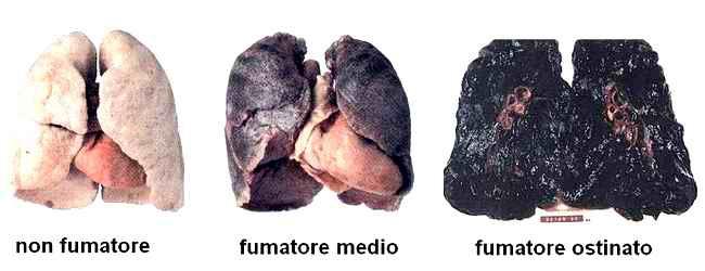 Un fumatore di circa 1 pacchetto/die per 20 anni, introduce nei