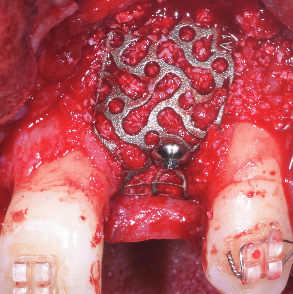 Rigenerazione Ossea perimplantare 2.