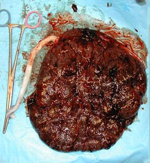 Placenta normale BLANDA AZIONE PRO-INFIAMMATORIA