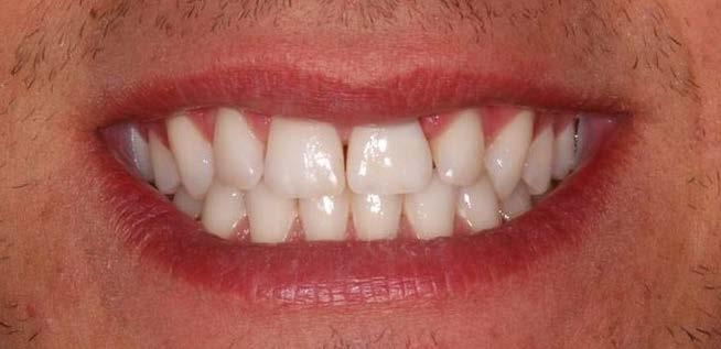 Spazio tra i denti (diastema) non estetico fra i due incisivi centrali superiori.