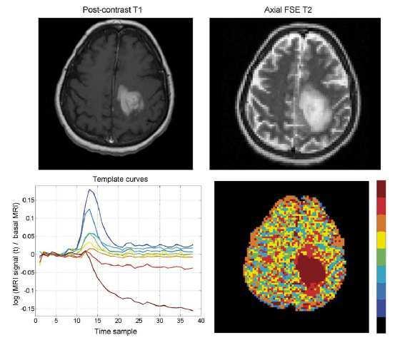 MRI Encefalo Costituisce lo standard nella diagnosi: - Estensione del tumore - Infiltrazione tessuti molli - Coinvolgimento leptomeningeo