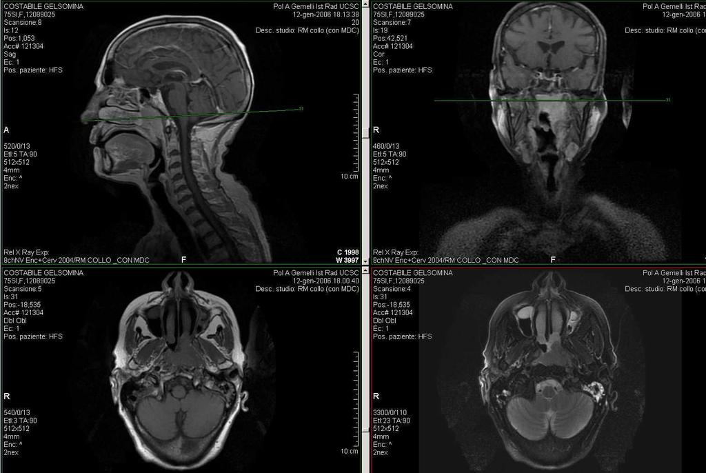 Definizione target: MRI Testa-collo!