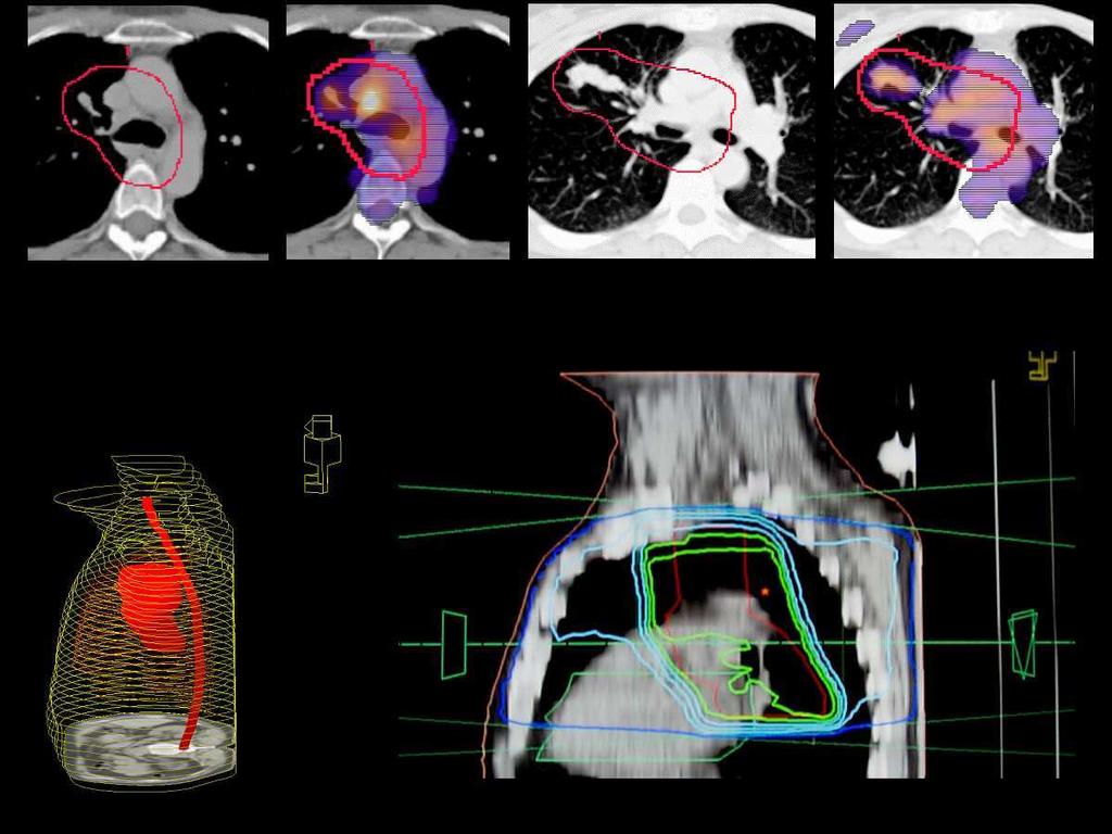 Molecular Radiation Treatment Planning (MRTP) Changes of Planning Target Volume (PTV) in 83% (63/76) of the patients Major increase of PTV: 5 / 76 pts (LN negativ in CT, LN mets in PET) Major
