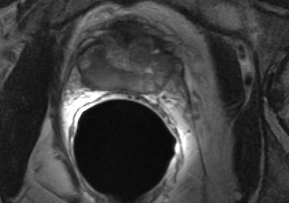 Prostata MRI - T1: