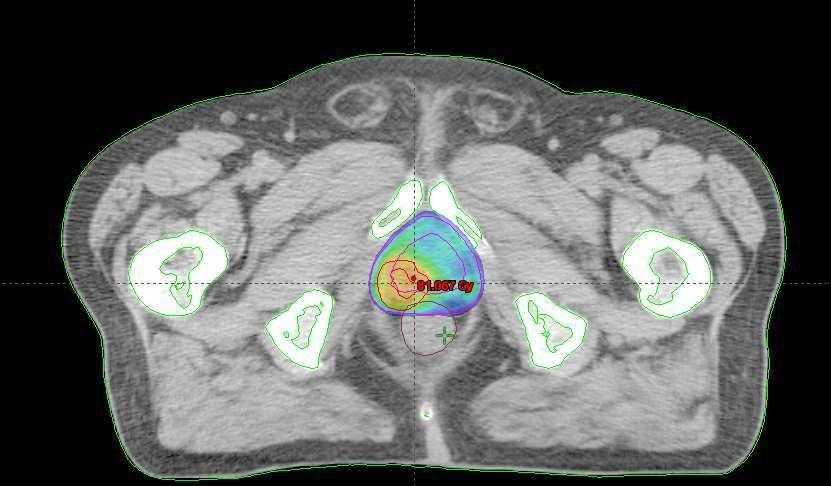 Prostata TC+MRI+MRS razionale nel treatment