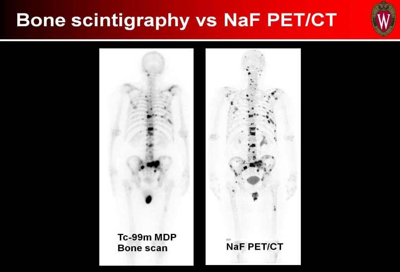 La NaF PET/TC sostituirà la scintigrafia scheletrica con TC99?