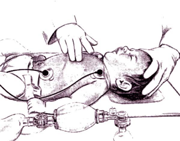 Fig. 13 - Massaggio cardiaco nell infante. Fig. 14 - Massaggio cardiaco nel bambino.