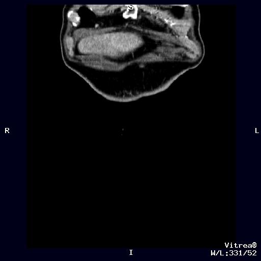 pancreas: metastasi epatiche