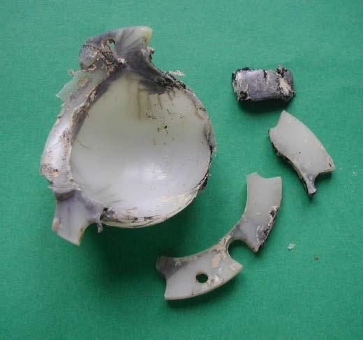 McKellop HA et al. Effect of sterilization method and other modifications on the wear resistance of acetabular cups made of ultra-high molecular weight polyethylene. A hip-simulator study.