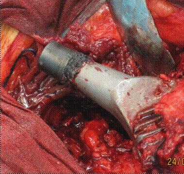 hard-on-hard hip replacement