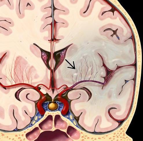 L ischemia cerebrale consiste in una riduzione del flusso ematico cerebrale o ipoperfusione a livello di