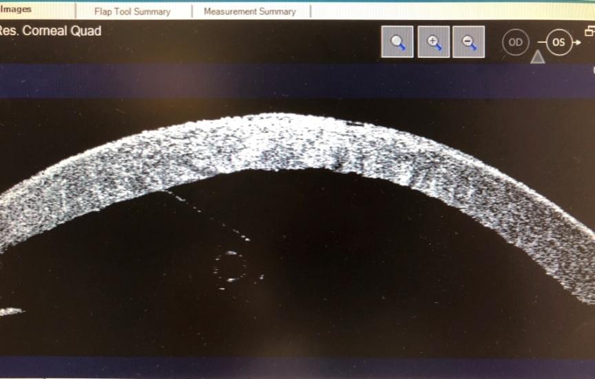 non-banded layer of DM The grafts from donors younger than