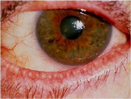 Sindromi da occhio secco nel paziente reumatologico MALATTIE