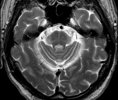 T2: iperintensità