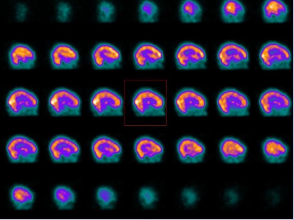 tau) PiB (amiloide) Scintigrafia cerebrale perfusionale con 99m