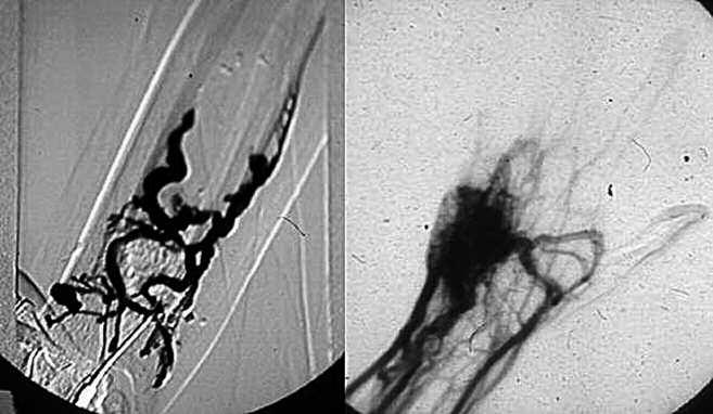 98 A B Figura 1. A, B) Quadro angiografico di fistola artero-venosa (FAV) e di malformazione artero-venosa (MAV).