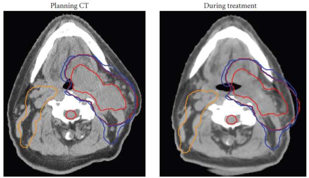 Perché IGRT (Image Guided Radiation Therapy)?