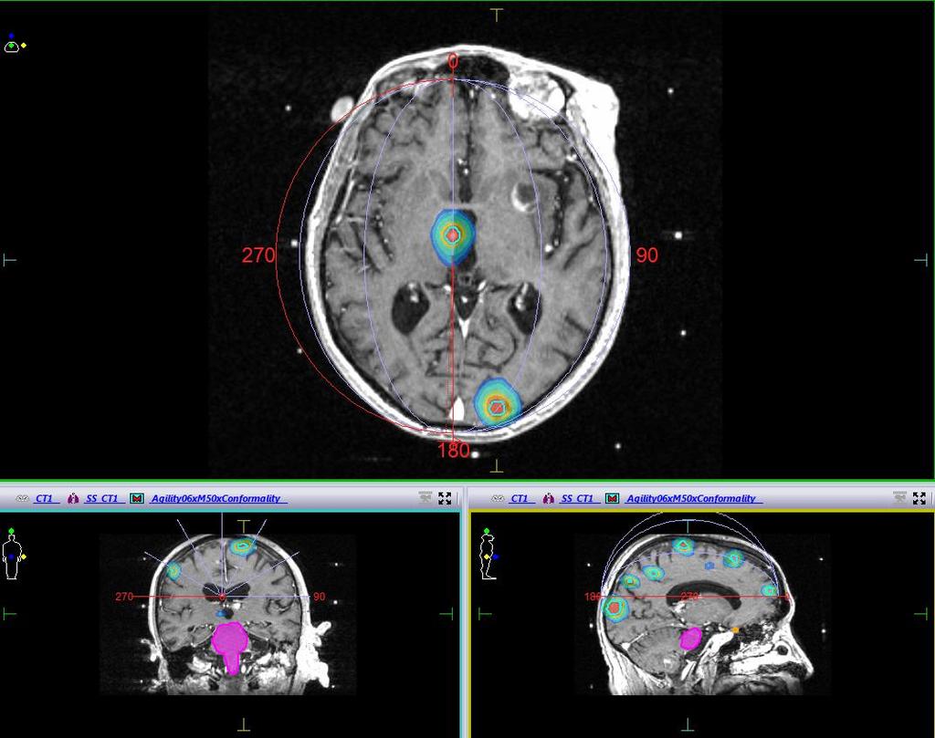 Elekta HDRS Trattare metastasi multiple (n 14) piccole (0,03 cc) Feasibility study of a single isocenter, non-coplanar VMAT for multiple brain tumors A clinical plan was used with a single isocenter