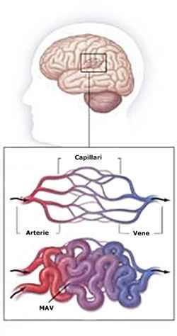 MAV : MALFORMAZIONI ARTERO-VENOSE CEREBRALI Le malformazioni artero-venose (MAV) sono delle anomalie vascolari caratterizzate da una comunicazione diretta, patologica, tra arterie e vene.