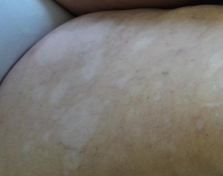 avvia terapia con: - prednisone 25 mg/die Biopsia cutanea: