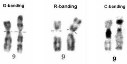 Confronto tra bandeggi G and R-banding results show the addition of chromosomal material in the short