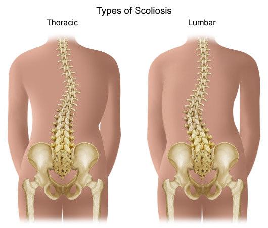 Problemi Internistici (VI) Apparato Scheletrico Scoliosi Osteoporosi