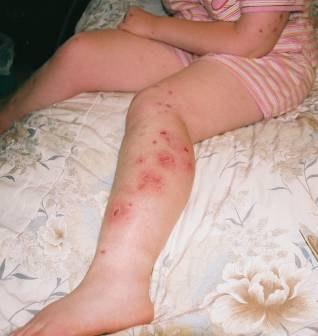 Problemi Internistici (VIII) Altro Alterazioni della termoregolazione Lesioni da skin picking Strabismo Elevata soglia del dolore Scarsa pigmentazione cutanea (rischio ustioni)