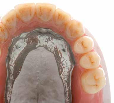 novo.lign 19 novo.lign e denti neo.lign 4 Visione occlusale del lavoro ultimato.