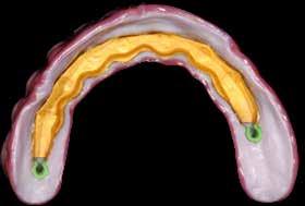 lign creano, durante la masticazione, la necessaria elasticità, proteggendo i denti antagonisti in arcata inferiore.