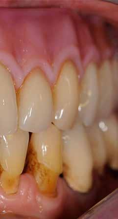 novo.lign 25 Dopo 10 anni Nonostante la rigidità del manufatto in zirconio non è presente alcuna abrasione a carico della dentatura naturale antagonista in arcata inferiore.