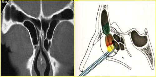 state classificate radiologicamente da Kuhn in quattro tipi: - Kuhn tipo I: presenza di una cellula fronto- etmoidale posta superiormente all agger nasi; - Kuhn tipo II: presenza di due o più cellule