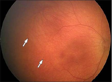 1984;102:1130-1134 2: Arch Ophthalmol.